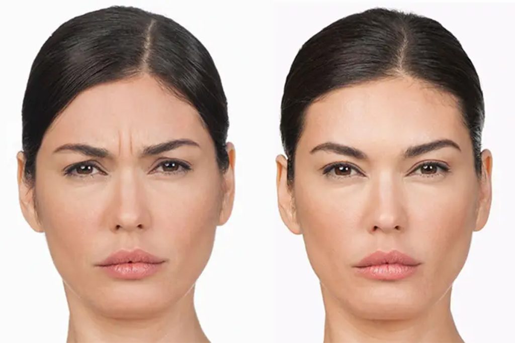 Μεσόφρυο Botox-Τι είναι και τι πρέπει να γνωρίζετε-Dr Koutsoukou Elina