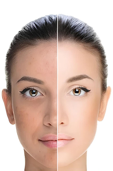 Τι είναι το Χημικό Peeling; Οδηγός για Οφέλη & Διαδικασία-Dr Koutsoukou Elina