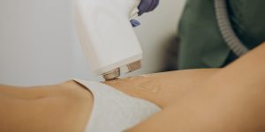 Τι Πρέπει να Κάνεις Πριν και Μετά το Λέιζερ Αποτρίχωσης-Dr Koutsoukou Elina